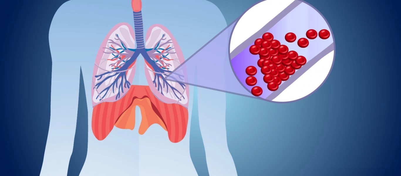 Προσοχή: Δείτε ποιοι κινδυνεύουν από πνευμονική εμβολή - Τι πρέπει να κάνουν